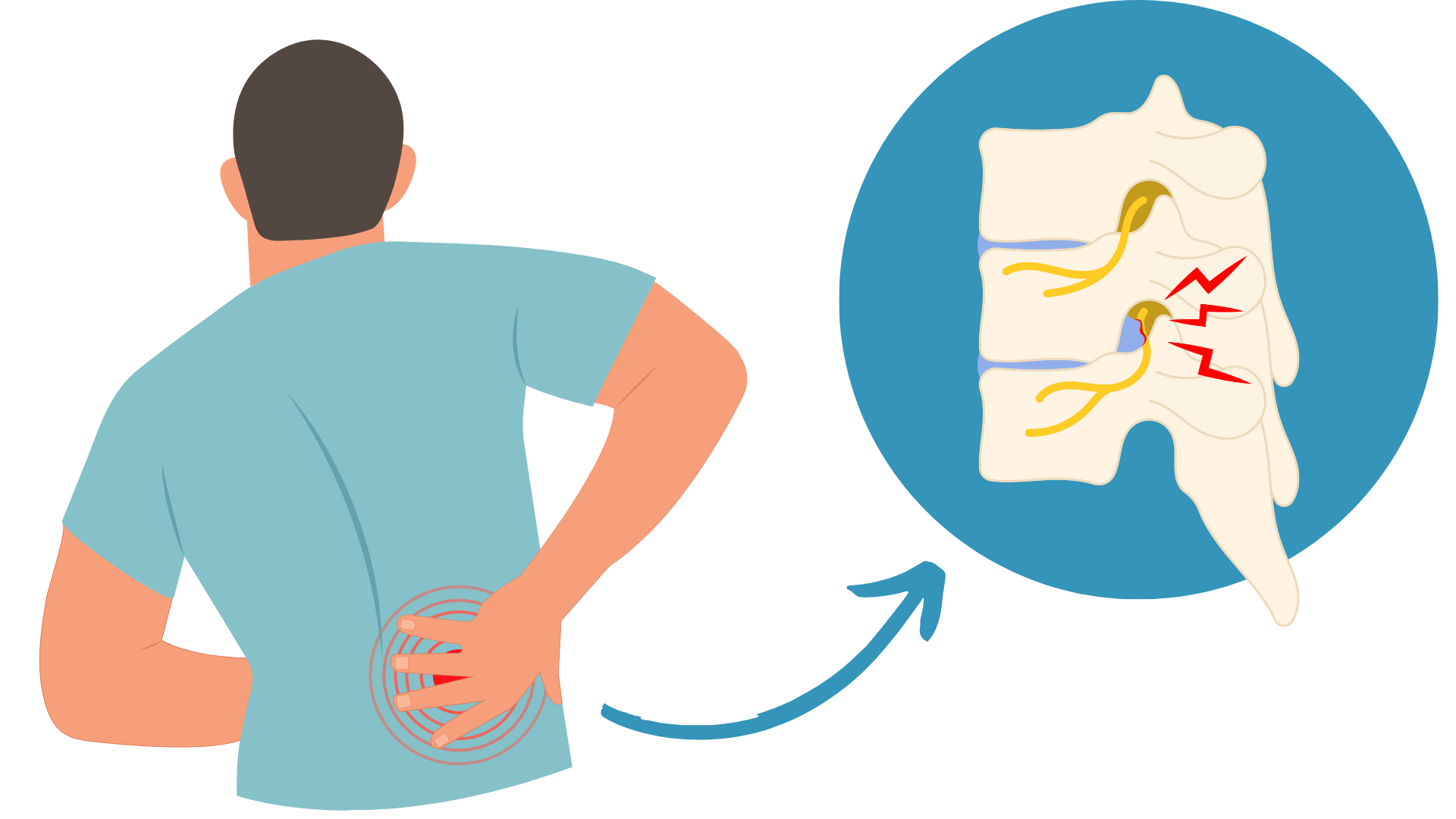 Sciatica treatment with Chiropractic Singapore