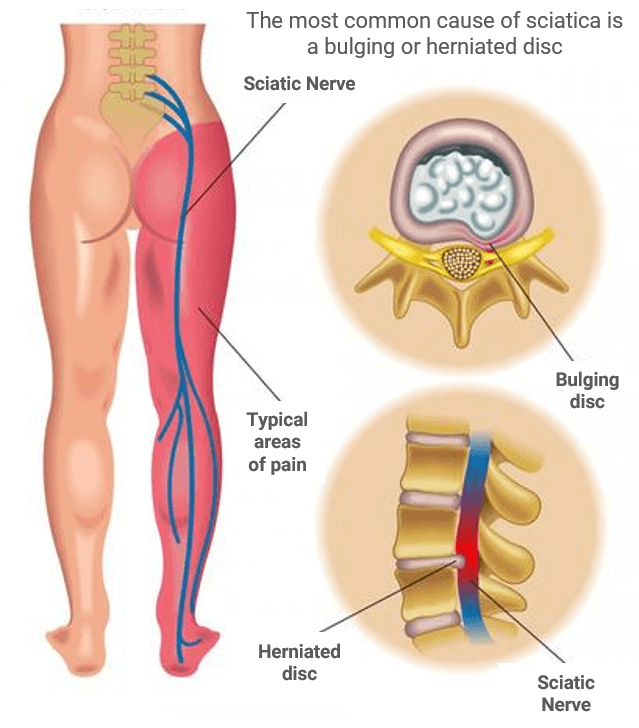 Chiropractic Singapore - Chiropractic for Sciatica Pain Infographic