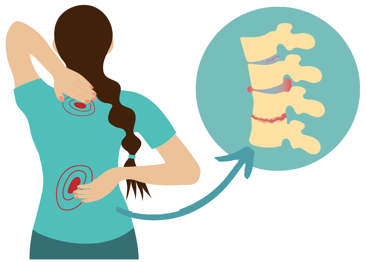 slipped disc diagram chiropractic Singapore