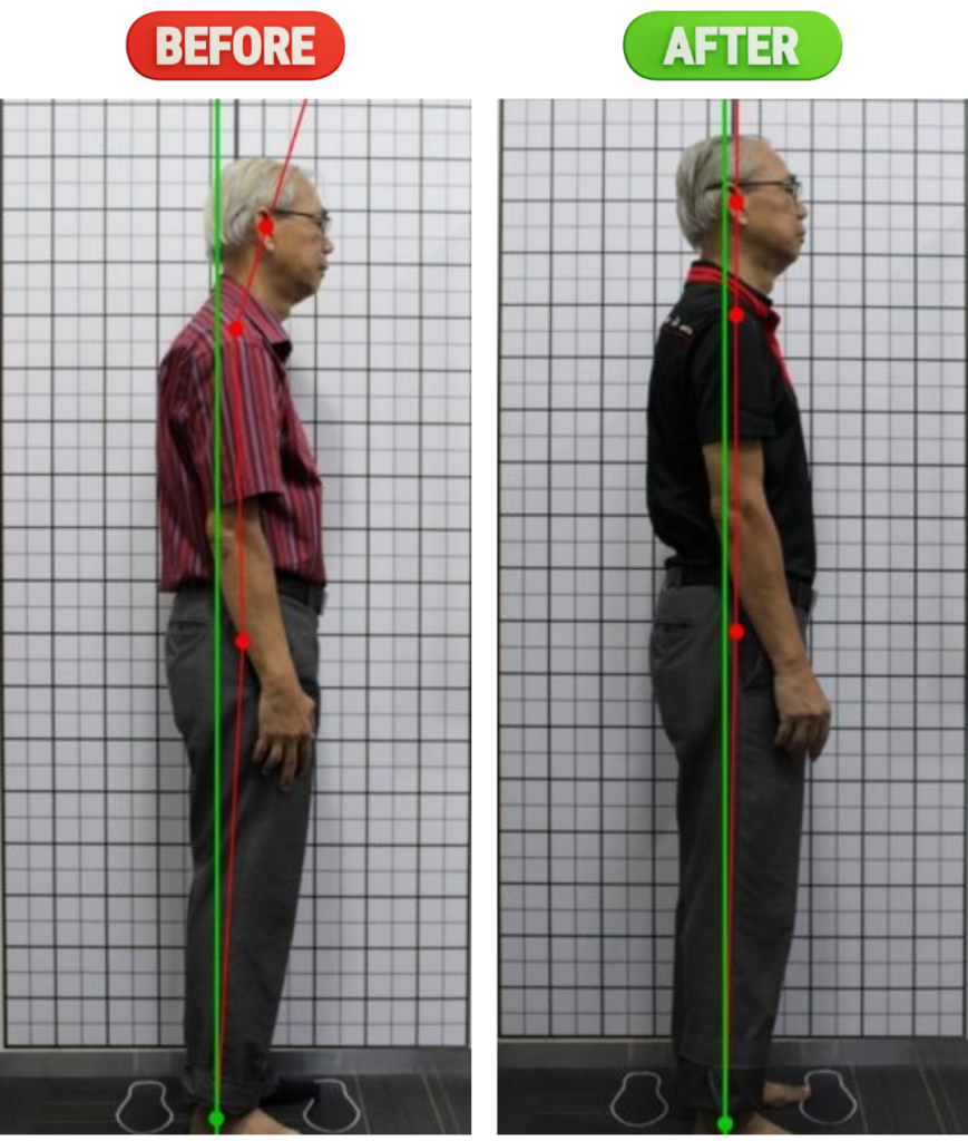 Before and after of Posture correction with chiropractic care at Chiropractic Singapore