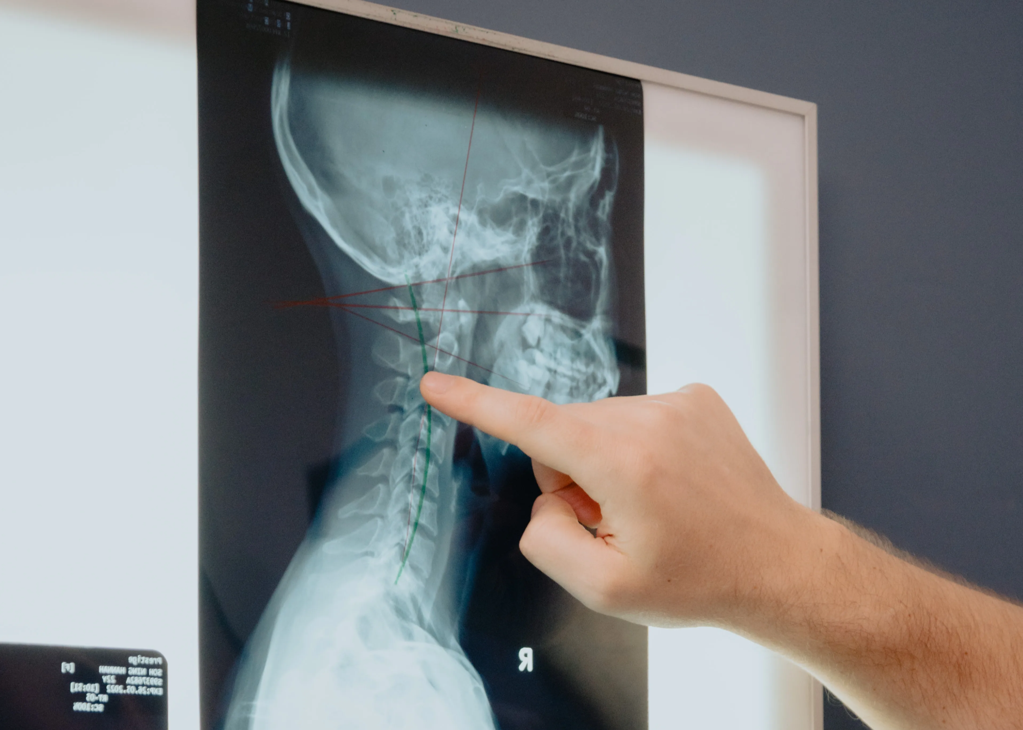 Text Neck: Relief and Treatment in Singapore