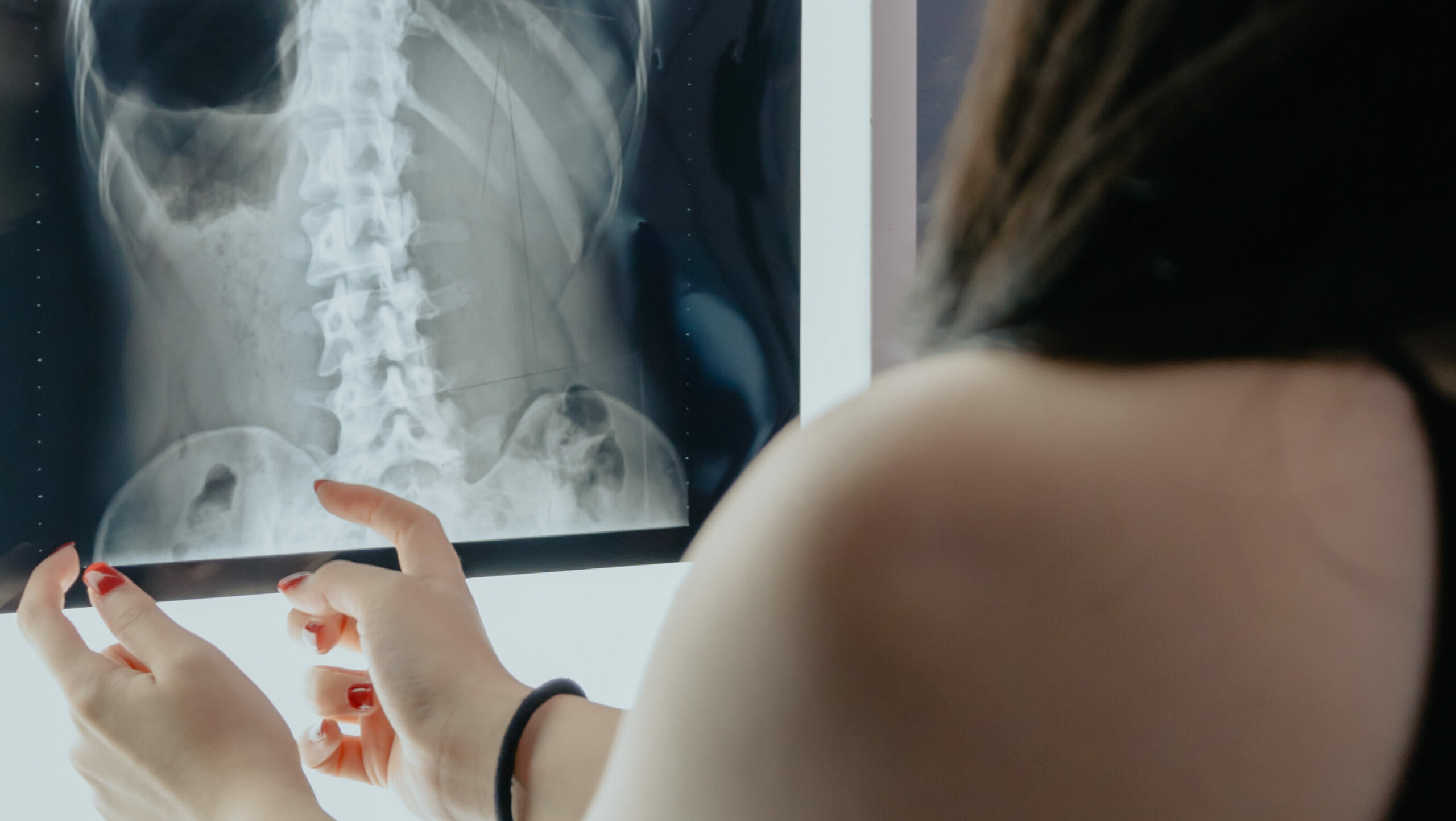 Can Chiropractic Help, Fix, or Cure Scoliosis? - Scoliosis Care Centers