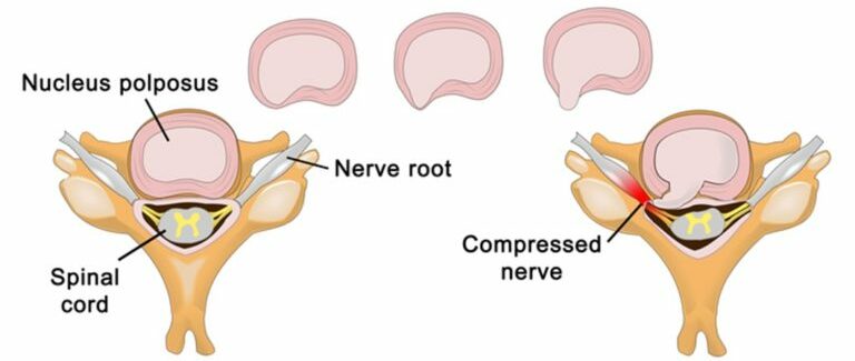 Slipped disc diagram for chiropractic care