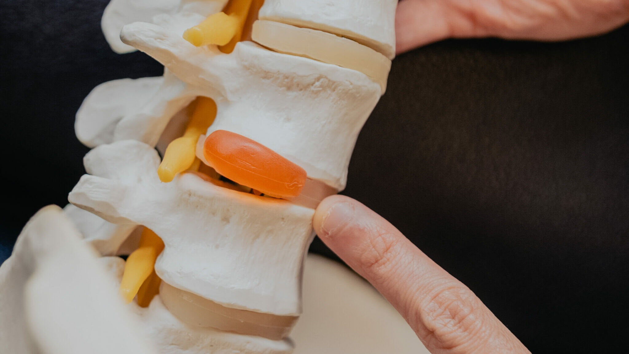 spine model with herniated disc during chiropractic consultation