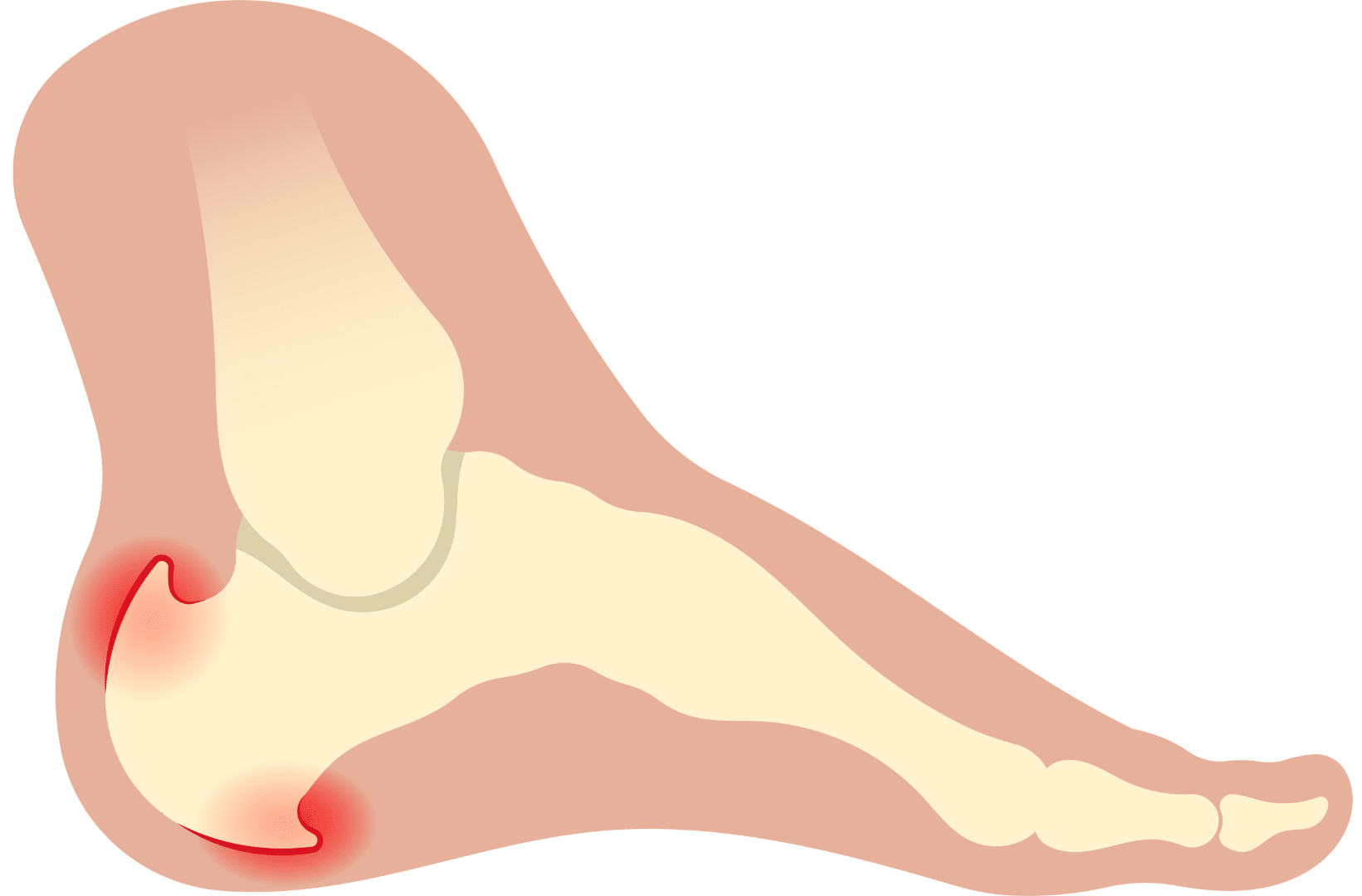 plantar fasciitis not related to arthritis Chiropractic Singapore