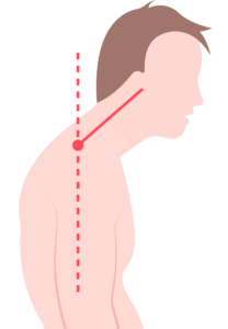 Types of bad posture - Forward head posture