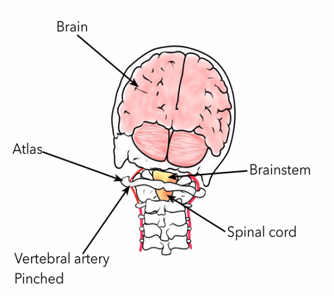 Migraine explained with pinched nerve diagram chiropractic care