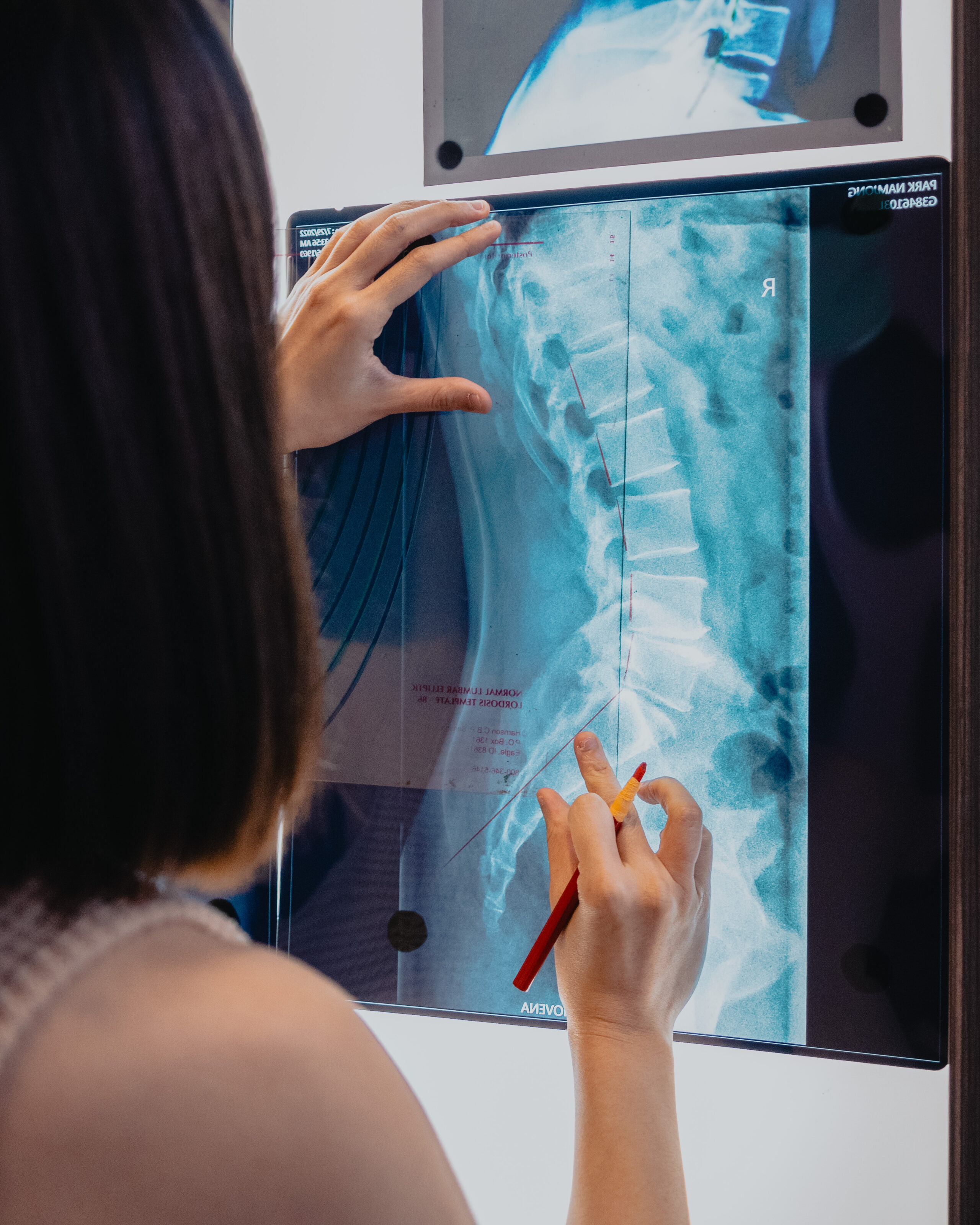 Spinal x-ray for Chiropractic care