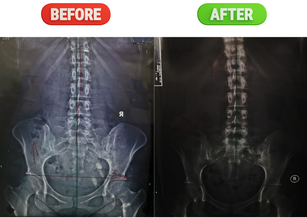 scoliosis before and after chiropractic care at chiropractic singapore