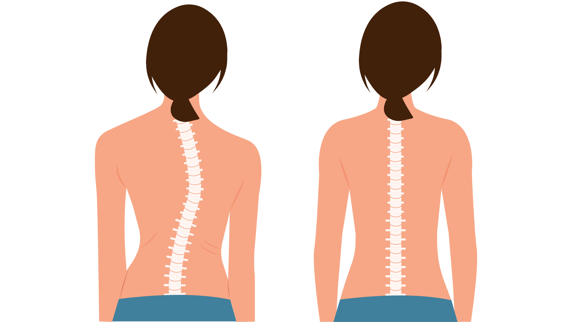 Scoliosis before and after diagram for chiropractic care