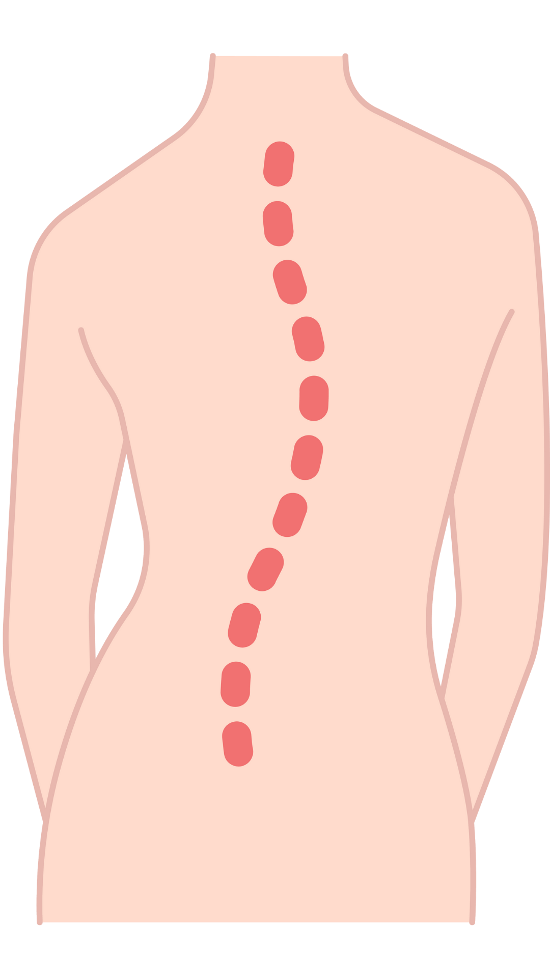 scoliosis diagram before chiropractic care