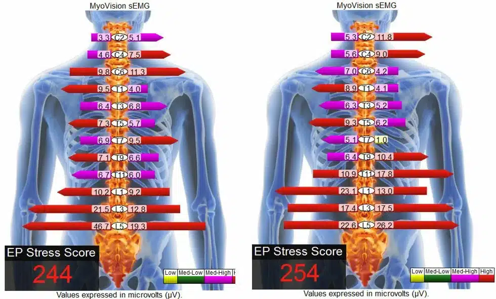 semg scan example for spinal screening