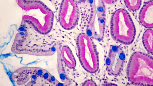 What Causes Gastritis? 