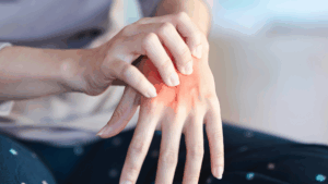Pinched Nerve in Arm and Hand