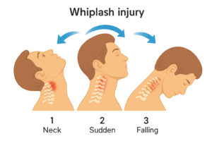Whiplash Injury Symptoms — How They May Relate to the Spine