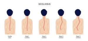 Scoliosis curvature of the spine four stages of disease development