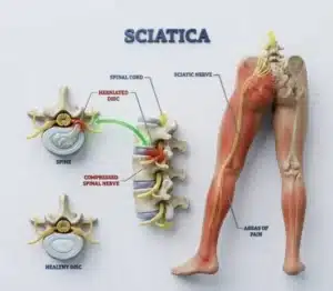Medical diagram showing a herniated disc compressing the sciatic nerve, highlighting reasons to seek targeted sciatica treatment in Singapore.