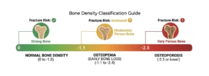 Bone Density Classification Guide showing T-score ranges and fracture risk levels for Normal Bone Density